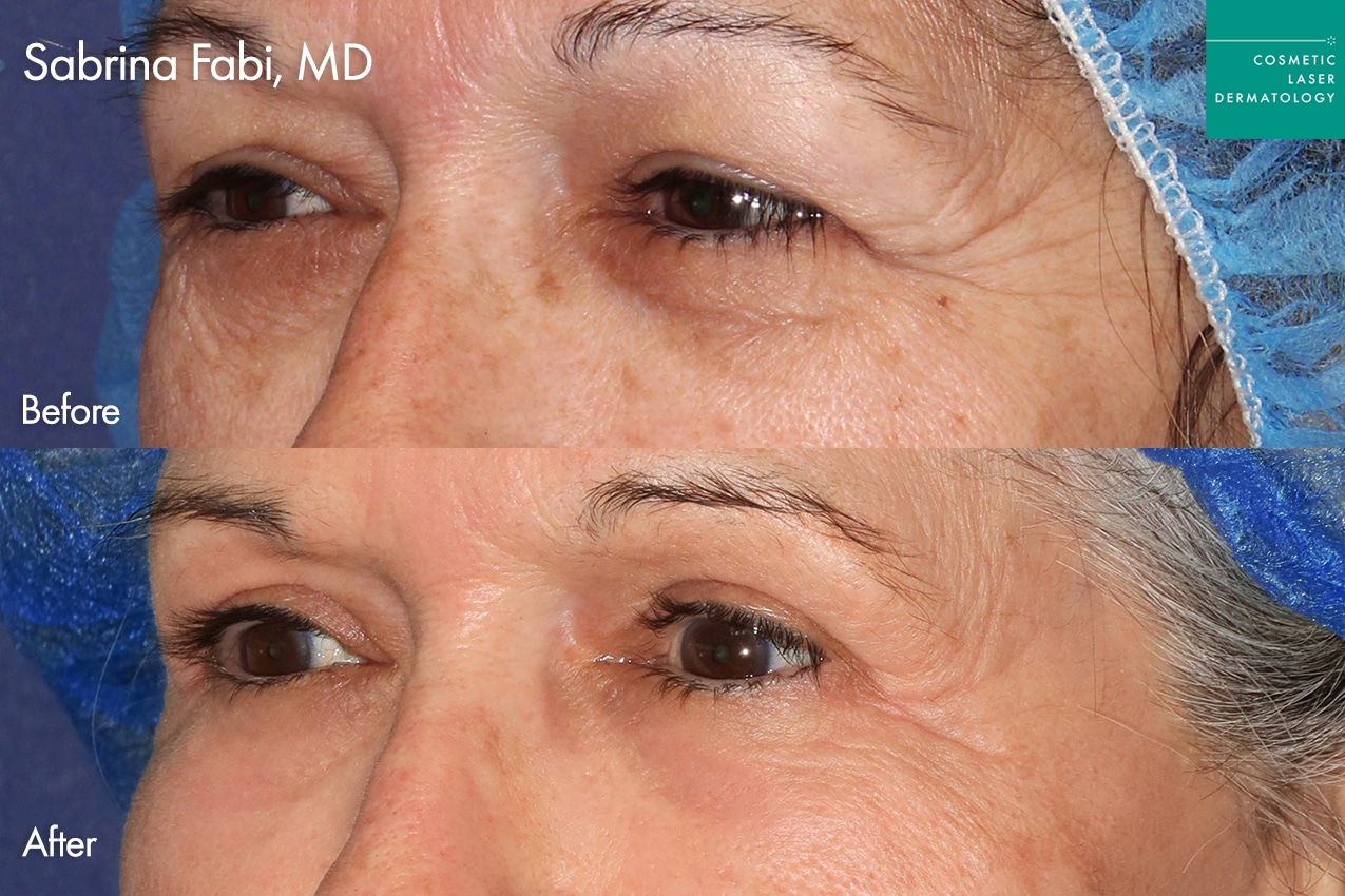 Take10Eyes by Dr. Fabi Before and After image