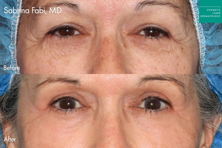 Take10Eyes by Dr. Fabi Before and After image