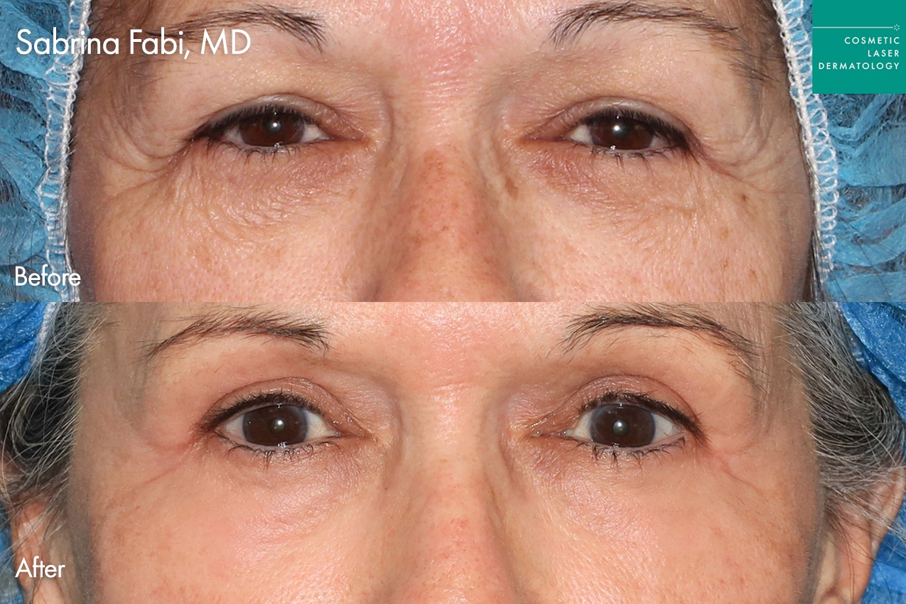 Take10Eyes by Dr. Fabi Before and After image
