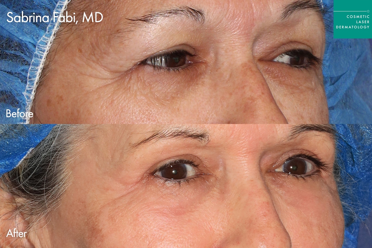 Take10Eyes by Dr. Fabi Before and After image