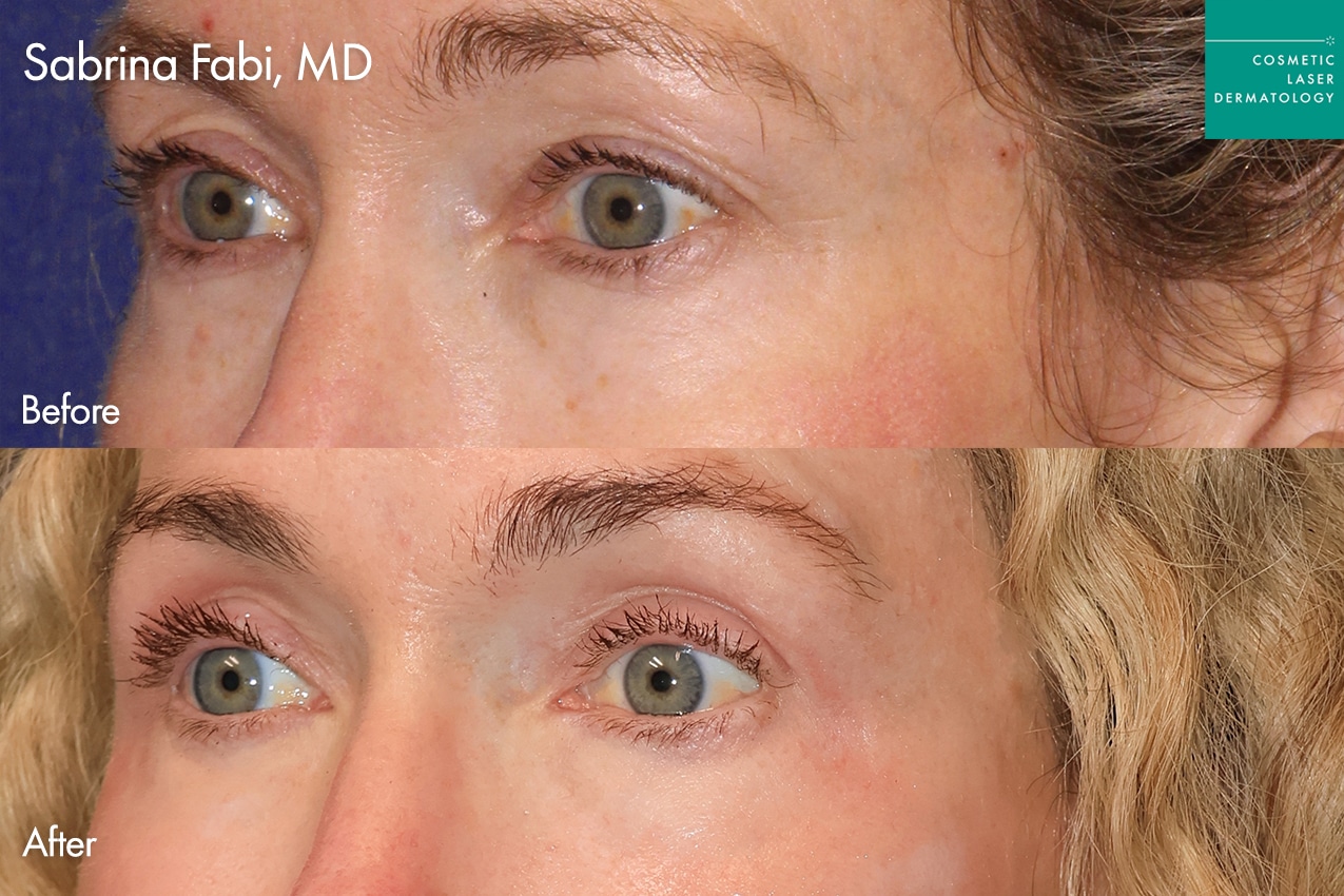 Take10Eyes by Dr. Fabi Before and After image