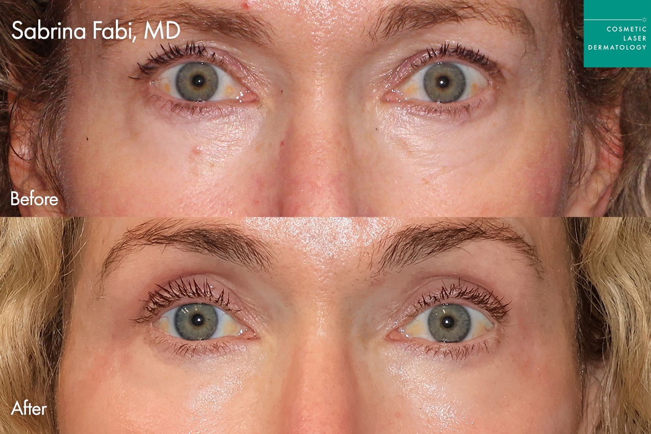 Take10Eyes by Dr. Fabi Before and After image