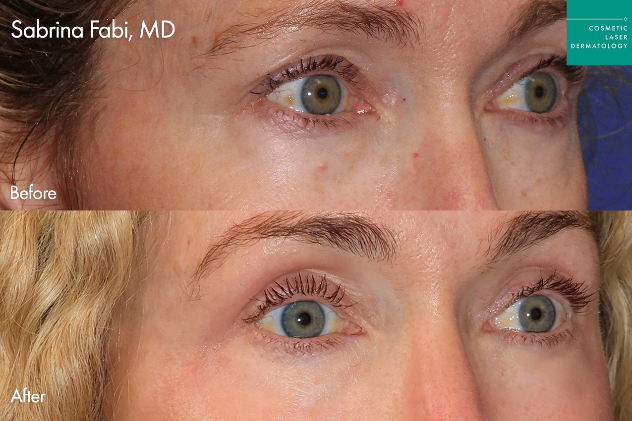 Take10Eyes by Dr. Fabi Before and After image