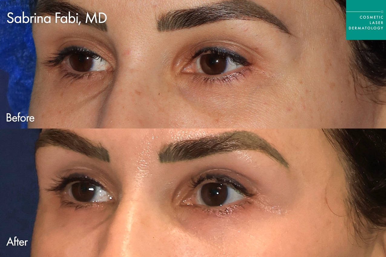 Take10Eyes by Dr. Fabi Before and After image
