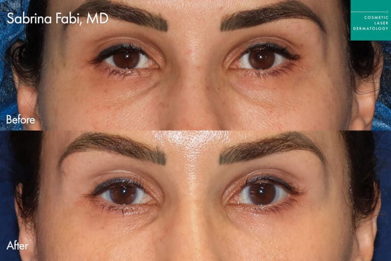 Take10Eyes by Dr. Fabi Before and After image