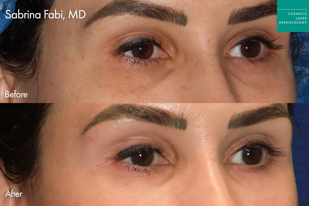 Take10Eyes by Dr. Fabi Before and After image
