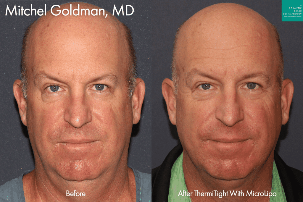Dr. GOldman skin tightening before and after