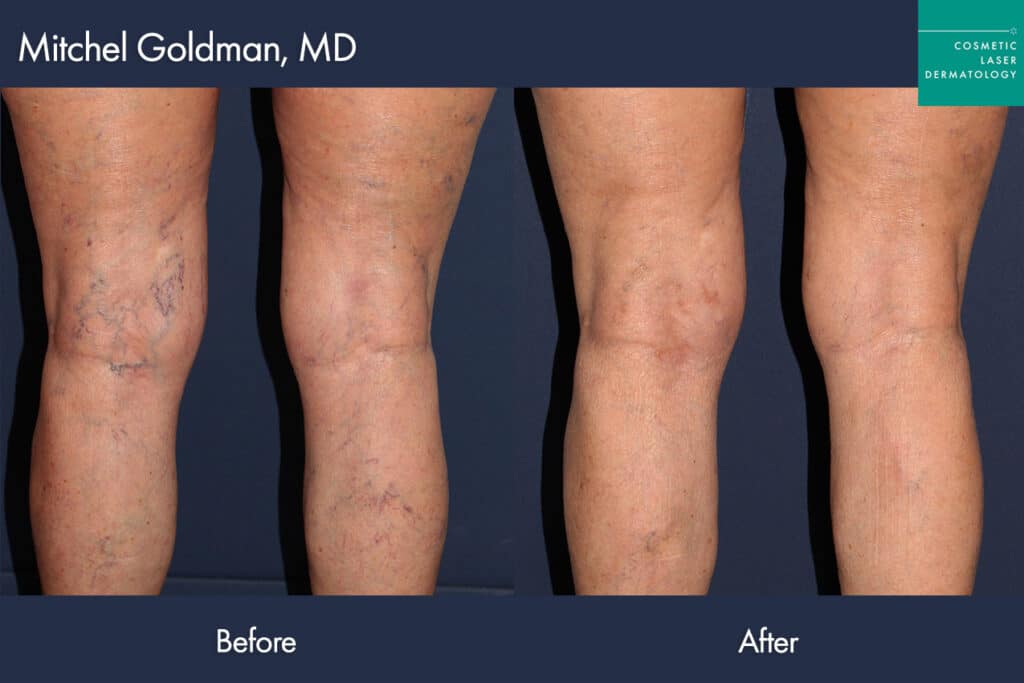 before and after sclerotherapy legs