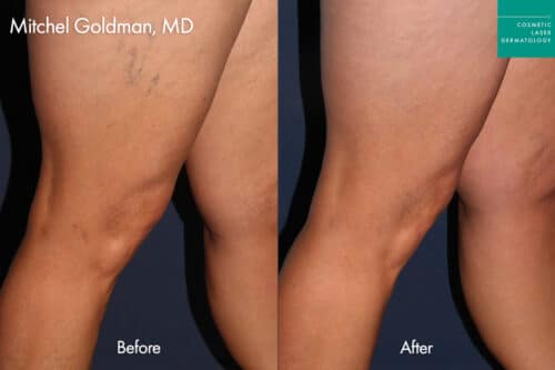 before and after sclerotherapy in san diego with Dr. Goldman