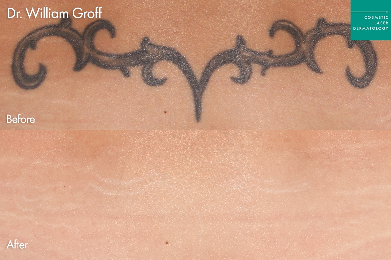 Tattoo Removal by Dr. Groff
