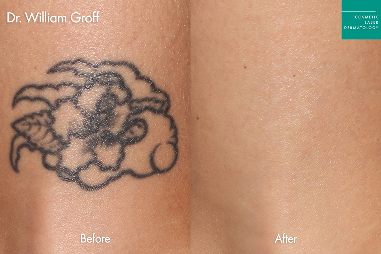 Tattoo removal before and after