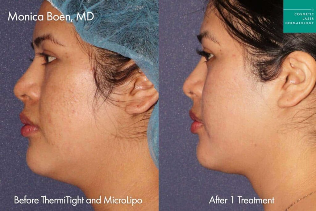 Dr. Boen skin tightening before and after
