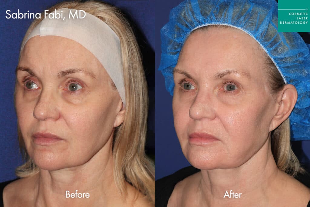 ultherapy before and after 