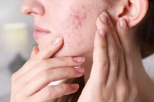 close up of woman with acne scars looking for laser procedure for acne scars in san diego