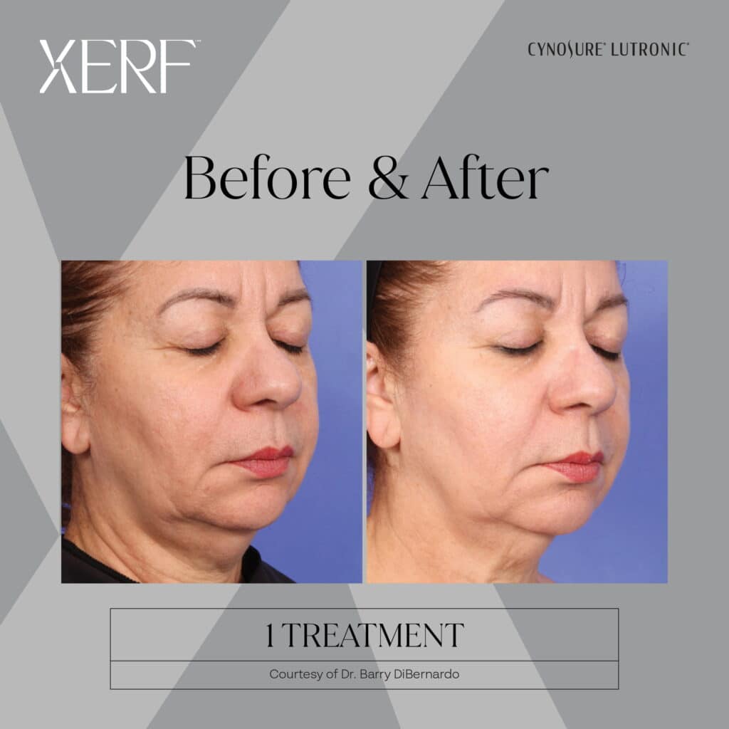 Xerf skin tightening Before and after photos
