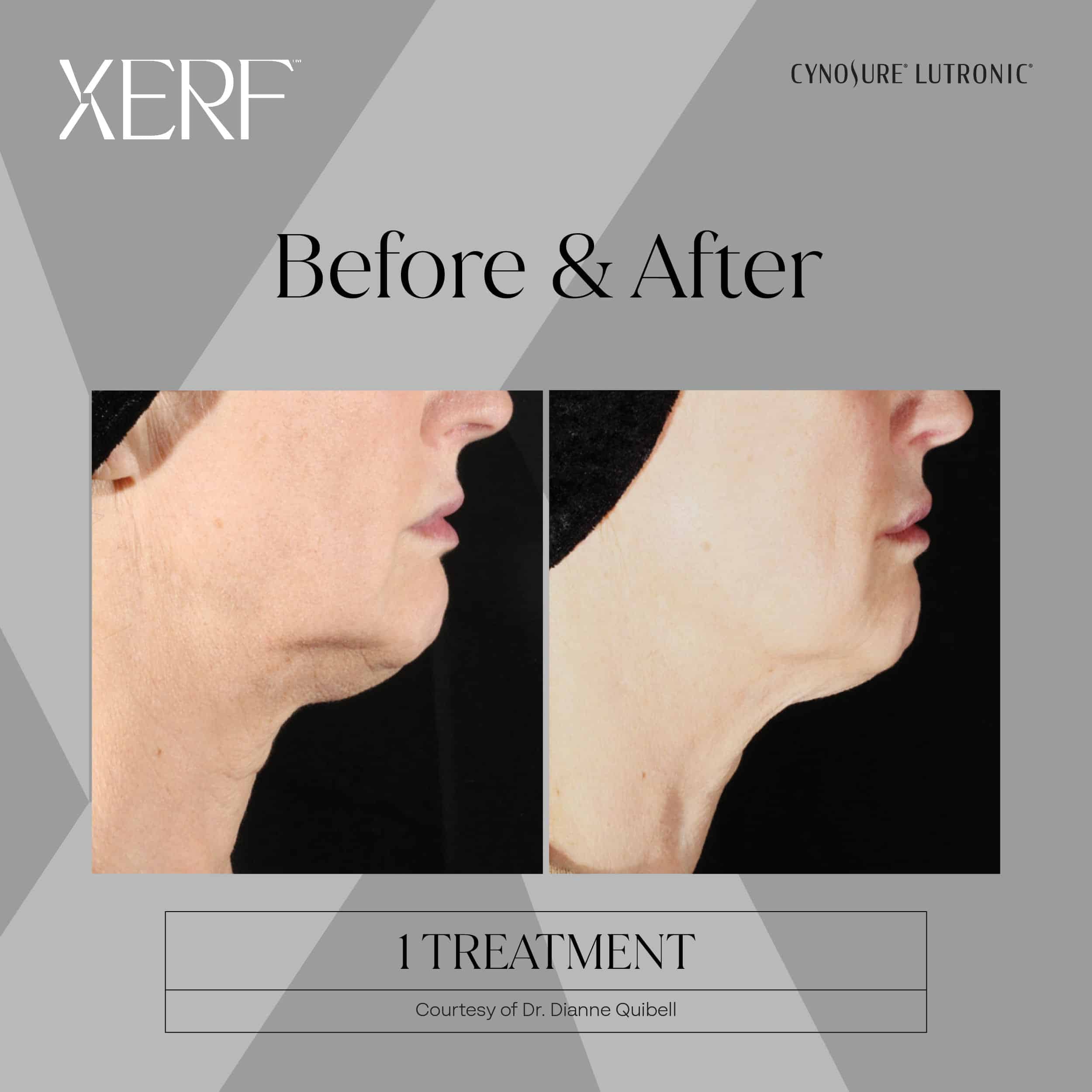Xerf skin tightening Before and after photos
