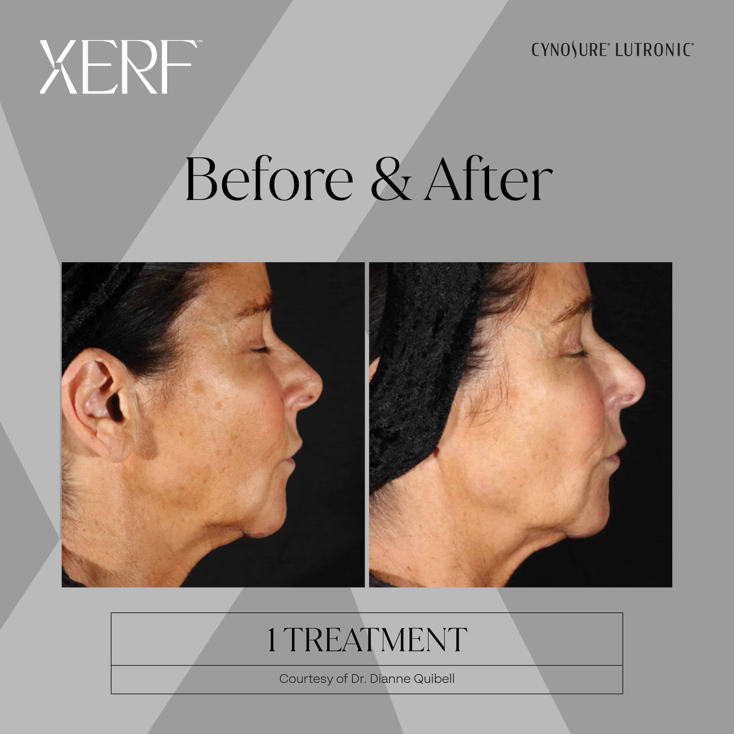 Xerf skin tightening Before and after photos