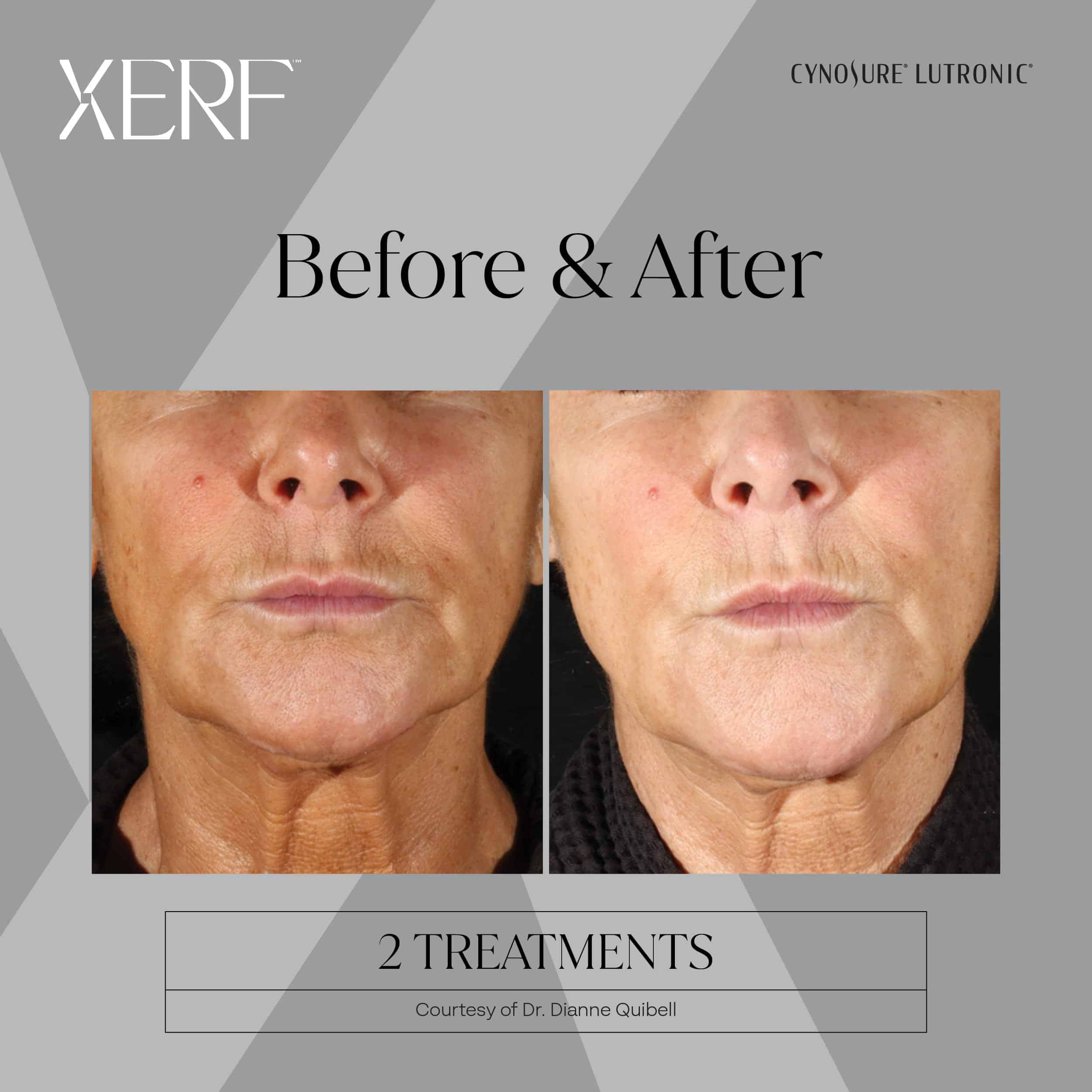 Xerf skin tightening Before and after photos