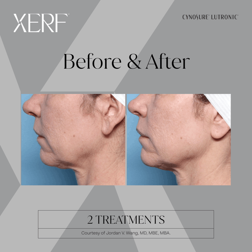 Xerf skin tightening Before and after photos