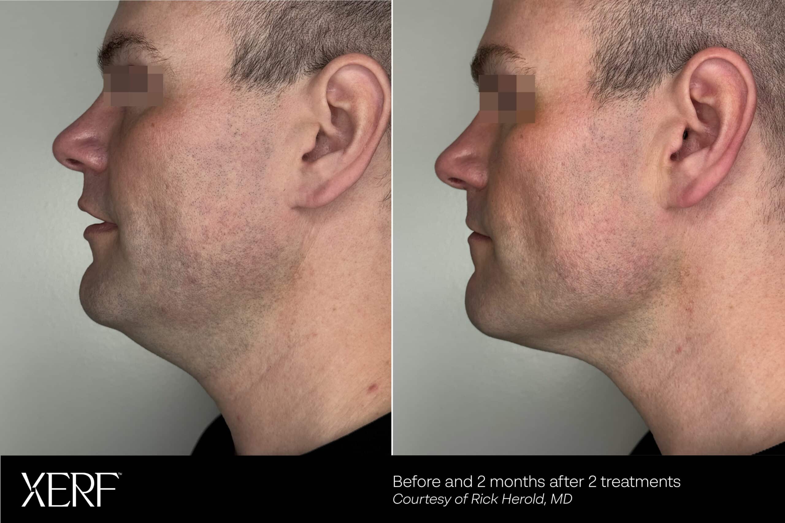 Xerf B&A